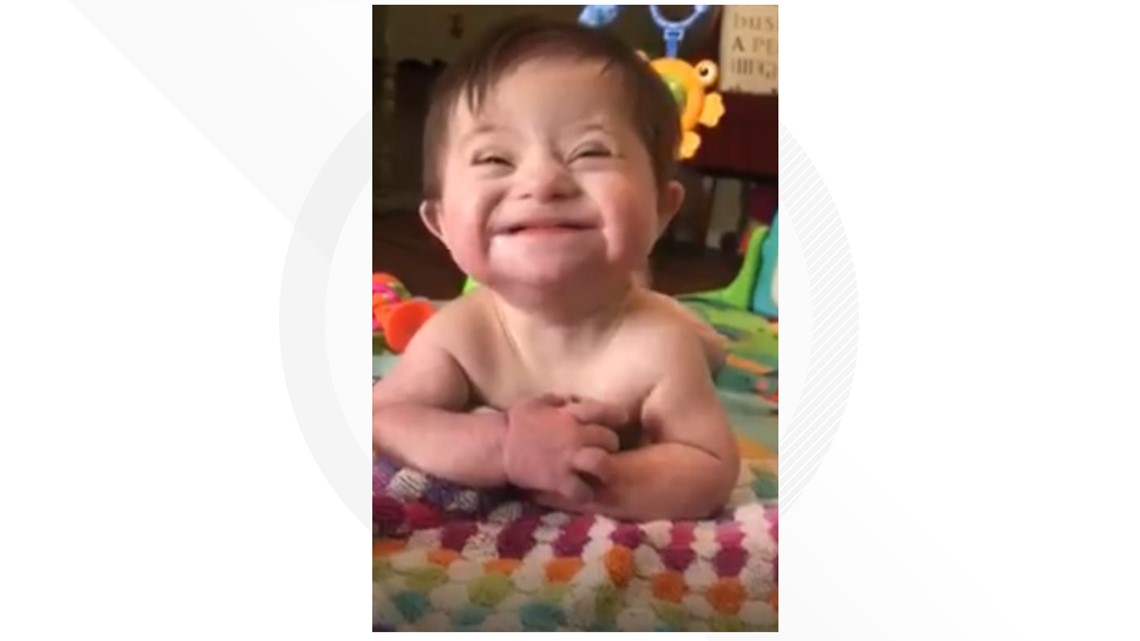 VIDEO Baby with Down syndrome smiling
