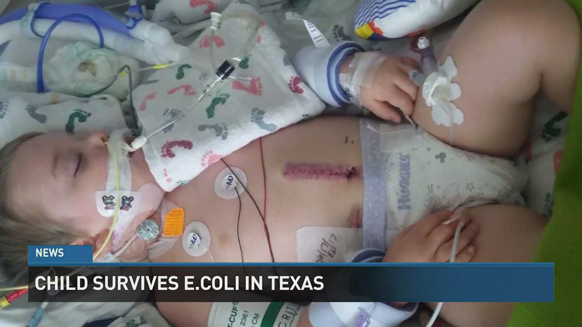 A two-year-old North Texas boy who battled back from a near-deadly case of E. coli is back home.