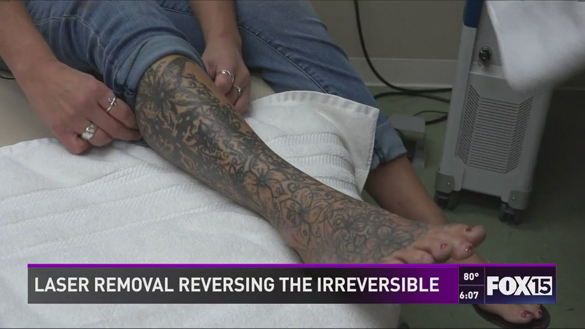 Emily Whitten starts initial treatment to have five-year-old tattoo removed.