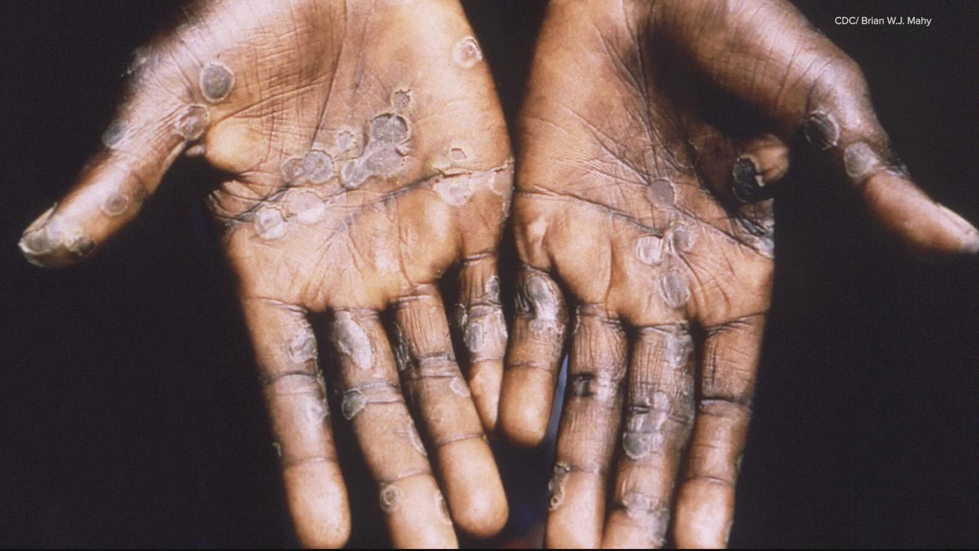 On May 18, a Massachusetts man tested positive for monkeypox. Here are 4 fast facts about the rare virus.
